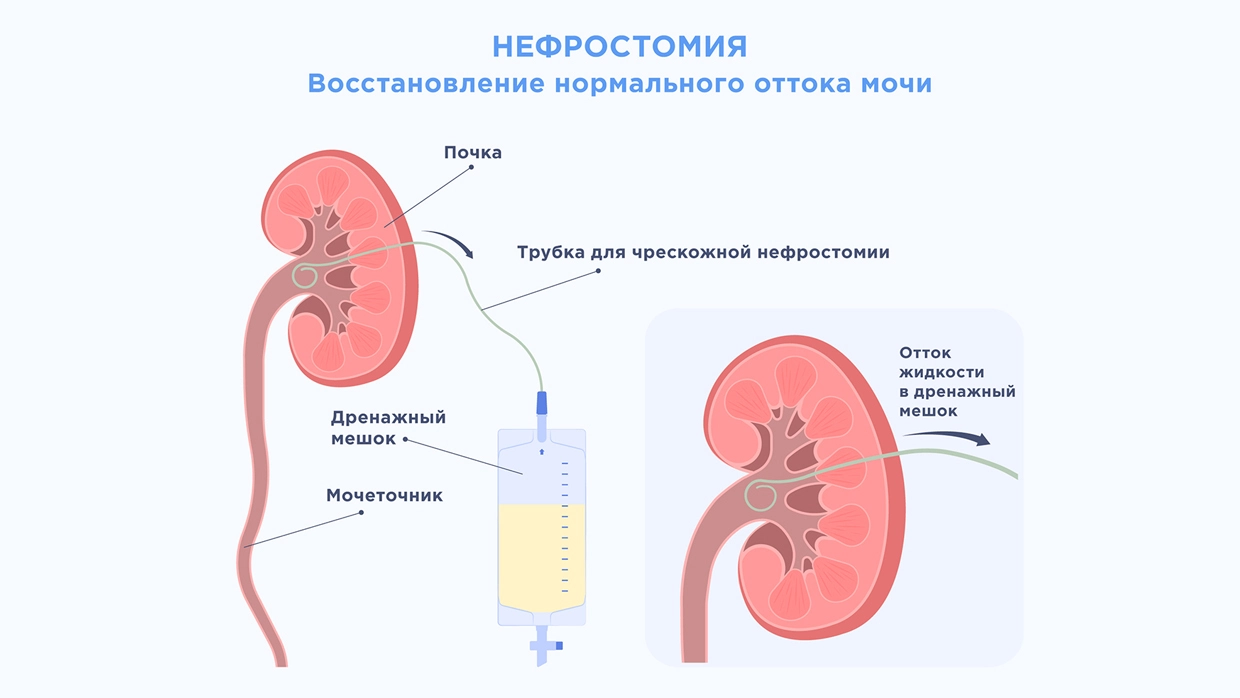 Стриктура мочеточника - причины, симптомы, диагностика и лечение